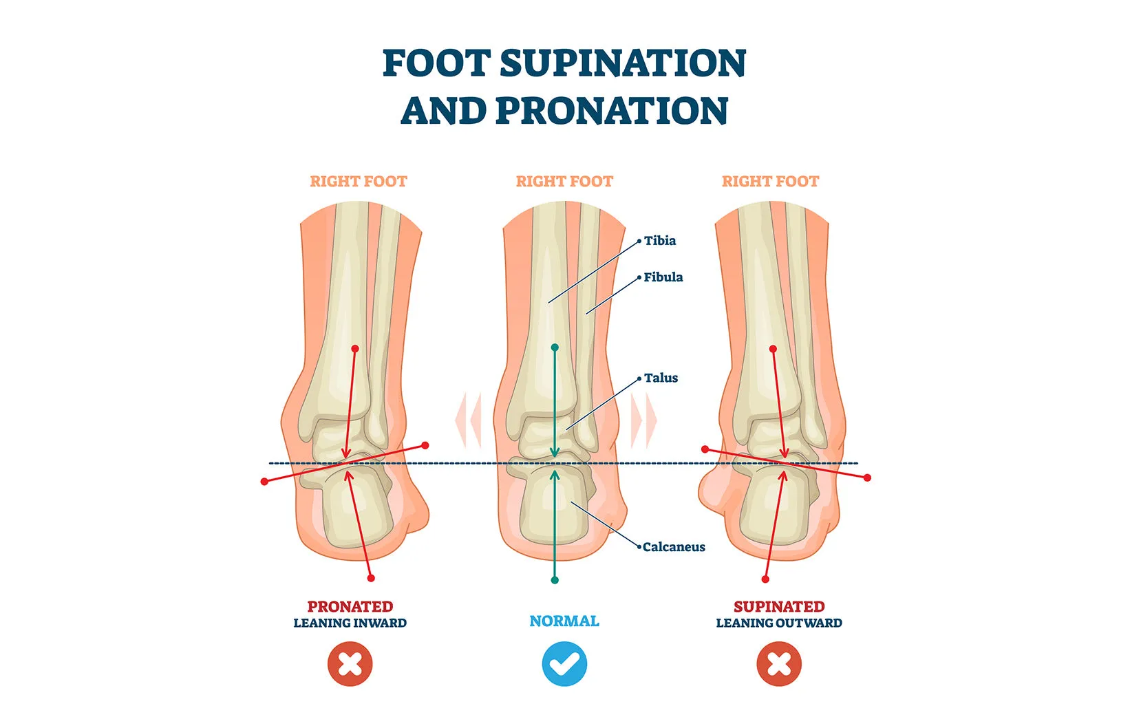 Pedag-Correct | pronation and supination pad